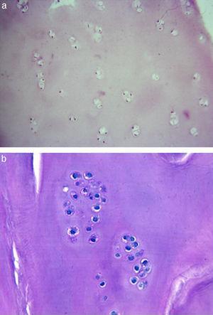 Tejido cartilaginoso neoformado a partir del implante de condrocitos autólogos en membrana teñido con hematoxilina-eosina. Se observa una baja celularidad (a) y a los condrocitos distribuidos en cluster (b).