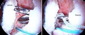 Implantes de doble sutura para poder utilizar independientemente para la sutura del labrum y para la sutura de la cápsula.