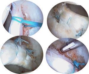 Tipos de sutura labral: sutura alrededor o sutura translabral.