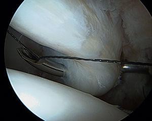 Penetración del dispositivo a través del labrum para realizar una sutura translabral.