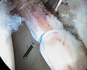 Imagen artroscópica mostrando la penetración de la broca de 1.4 para realizar una sutura transósea.