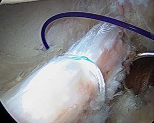 Sutura tipo PDS a través del agujero transóseo con el fin de servir de guía para la sutura definitiva.