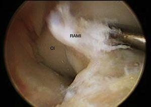 Imagen artroscópica desde el portal anterolateral donde se aprecia la desinserción de la raíz anterior del menisco interno. CI: cóndilo interno; RAMI: raíz anterior del menisco interno.
