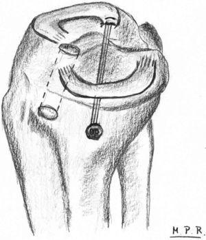 Esquema de los túneles óseos para la plastia del LCA y para la reinserción de la raíz posterior del menisco externo.
