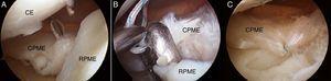 Imágenes artroscópicas desde el portal central anterior de la reinserción de la raíz posterior del menisco externo. A. Paso del hilo de sutura mediante el dispositivo de sutura meniscal a través del túnel óseo. B. Recuperación del hilo doble mediante pinzas artroscópicas a través del túnel óseo. C. Menisco reinsertado con hilo de sutura doble. CE: cóndilo externo; CPME: cuerno posterior de menisco externo; RPME: raíz posterior de menisco externo.
