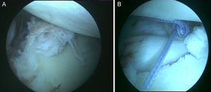 Caso 1, hombro derecho. A. Vista desde el portal de anterosuperolateral de la lesión del labrum posterior. B. Imagen después de la reparación con 2 anclajes.