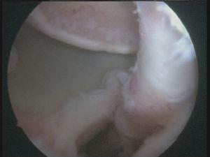 Caso 2, hombro izquierdo. Visión desde el portal ASL de la lesión de Hill-Sachs inversa (afecta a un 35% de la cabeza). Imagen tras preparar el lecho óseo de la lesión y la relación con el tendón del subescapular.