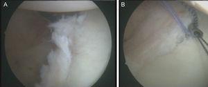 Caso 2, hombro izquierdo. A. Visión desde el portal ASL de la lesión del labrum posterior. B. Misma imagen tras la inserción del implante con 2 suturas y uso de pasador indirecto para la reparación de la lesión.