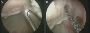Caso 2, hombro izquierdo. A. Visión desde el portal ASL de la inserción del implante más inferior en el defecto óseo, desde el portal anterior. B. Imagen de la cara posterior del subescapular, con la pinza penetrator recuperando una de las suturas.