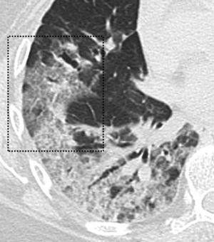 CCT image. 60-year-old patient with a positive PCR result for SARS-CoV-2. The CCT study shows the crazy-paving pattern (black box) is observed, as a result of the ground-glass opacities overlapping associated with inter and intralobular septal thickening.
