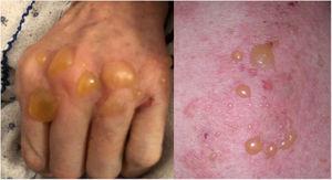 Tense blisters with serous contents over a slightly erythematous base of urticariform morphology.