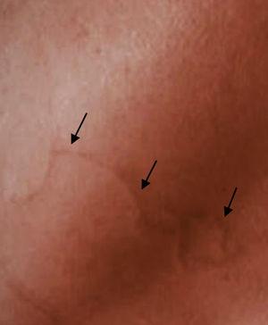 Serpiginous and erythematous linear rash (larva currens) in the abdominal region. The black arrows indicate the path of the rash.