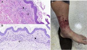 (A) Histopathological findings in skin biopsy with haematoxylin-eosin staining. B) Histopathological findings in skin biopsy with PAS. : deposition of fibrinoid material, isolated microthrombi and prominent endothelium. : leukocytic infiltration with leukocytoclasis and blood extravasation. C) Allergic vasculitis. * Skin lesions compatible with palpable purpura.