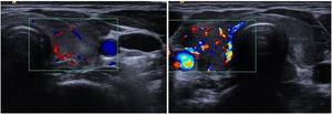 Figure no. 1: Thyroid ultrasound of the cases described in the article: Left: Ultrasound image of case number 1. Right: Ultrasound image of case number 2.