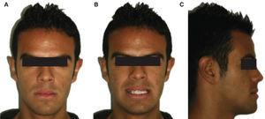 Initial facial examination. A. Frontal view, B. Smile C. Profile.