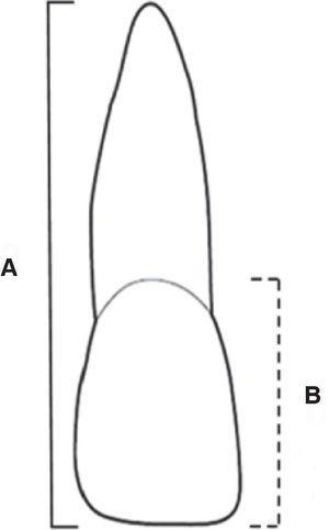 Mediciones realizadas en cada diente: A. Longitud total, B. Longitud coronal.