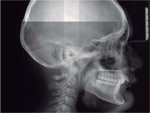 Cefalografía lateral inicial.