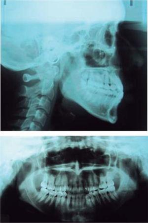 Radiografías iniciales: ortopantomografía.