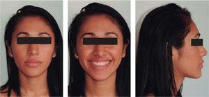 Final facial photographs. Note the improvement in the patient's profile and smile.