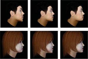 Imágenes de perfil facial modificadas en el tercio inferior de la cara por un software para obtener los perfiles dolicofacial, proporcionado y braquifacial.