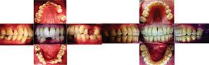 Comparación antes y después del tratamiento de ortodoncia. Retenedores: superior con alambre de acero 0.014 en cara vestibular e inferior placa Hawley con póntico provisional en O.D. 41.