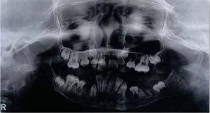 Ortopantomografía posterior al tratamiento.