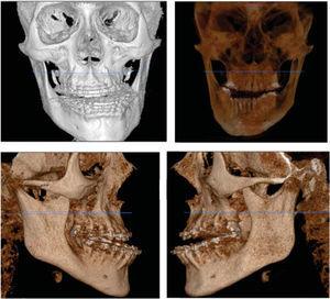 Tomografía computarizada que muestra el grado de discrepancia y asimetría maxilomandibular.