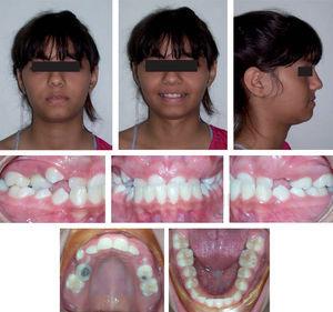 Face, arches and occlusion pre-treatment photographs.