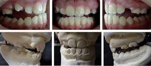 Clinische functionele analyse en articulator montage.