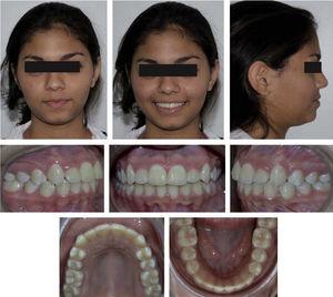 Face, arches and occlusion final photographs.