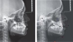 Final lateral headfilm, superimposition and measurement comparison.