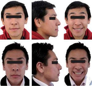Fotografías extraorales de frente, perfil y sonrisa anteriores y posteriores al tratamiento.