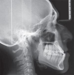 Radiografía lateral.