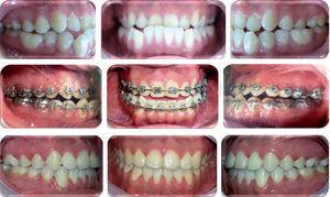 Initial, progress and final intraoral photographs.