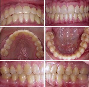 A functional occlusion with a correct overbite and overjet was obtained.