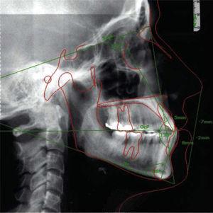 Cefalografía lateral inicial.