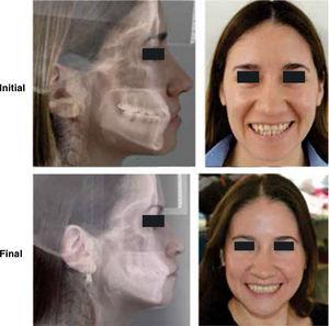 Oral and facial relationship at the beginning and at the end of the interdisciplinary treatment.