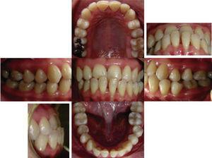 Initial intra oral photographs.