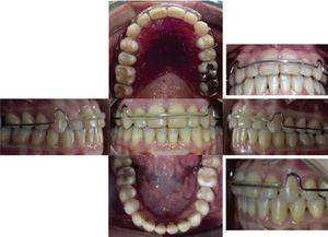 Lower fixed and upper circumferential retainers.