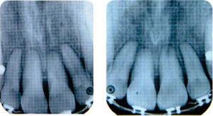 Periapical radiographs before and after the intrusion movement.
