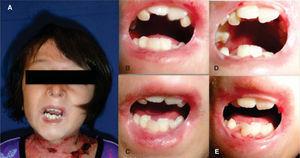 A) Facial photograph, B, C) microstomia and crowding during initial examination, D, E) follow-up photographs where the progression of the microstomia can be observed as well as the severe crowding upon eruption of the permanent incisors.