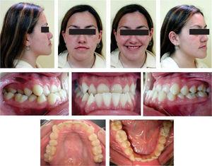 Initial intraoral and facial photographs.