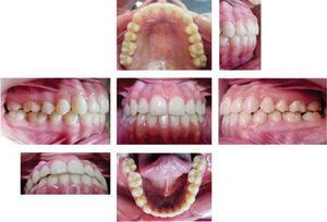 Postreatment intraoral photo gallery.