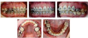 Intraoral treatment photographs: right side, frontal view, left side and upper and lower occlusal photographs.