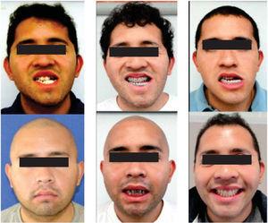 Facial changes during treatment.