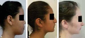 Photographs of facial biotypes: A. Dolichofacial, B. Mesofacial and C. Brachifacial. Source: Direct.