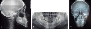 Radiografías iniciales: A. Lateral de cráneo, B. Panorámica y C. Posteroanterior.