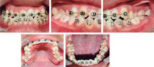 Intraoral photos. A. Front. B. Right side. C. Left side. D. Upper occlusal. E. Lower occlusal.