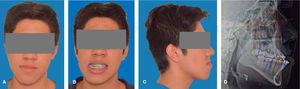 Presurgical facial photographs. A. Frontal. B. Smile photograph. C. Right profile. D. Presurgical lateral headfilm.