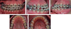 Presurgical intraoral photographs. A. Frontal. B. Right side. C. Left side. D. Upper occlusal. E. Lower occlusal.